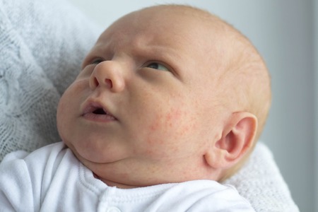 Portrait of a newborn baby with manifestations of an allergy on the face