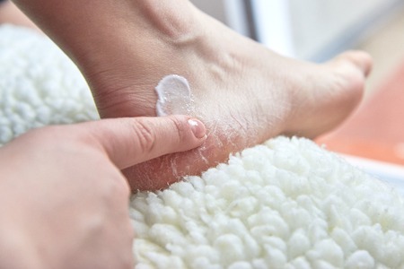 Girl smears moisturizing cream dry feet covered with cracks