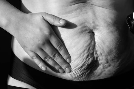 Woman smears nutritious cream sagging flabby belly with stretch marks, close-up, black and white photo.の写真素材