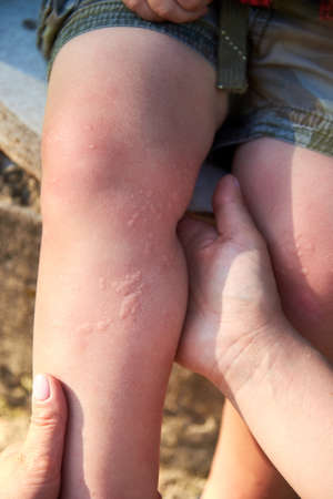Burns from the nettle grass on the boy's legs, an allergic reaction to plants.の写真素材