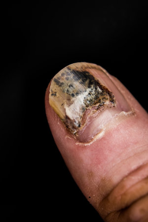 Onycholysis, Detachment Of Nail From Nailbedの写真素材