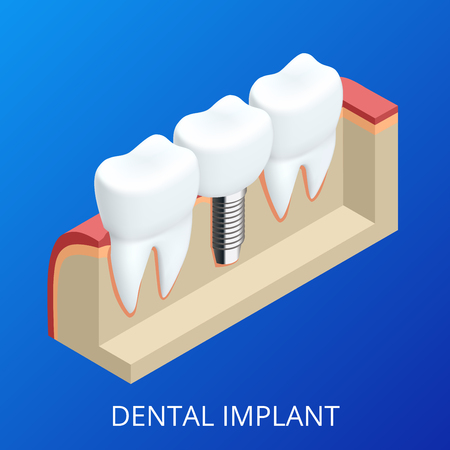 Isometric Tooth human implant. Dental concept. Human teeth or dentures. 3d illustration Isolated. Realistic vector illustrationのイラスト素材