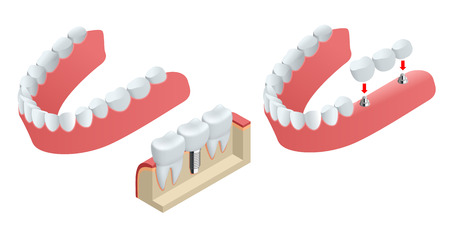 Isometric Tooth human implant. Dental concept. Human teeth or dentures. 3d illustration Isolated on white Realistic vector illustrationのイラスト素材