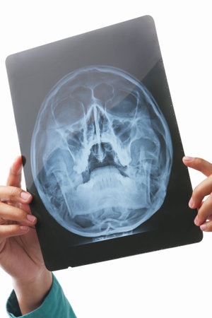 Hand holding xray image of skull area. PS: film grain is visible on the xray negative film
