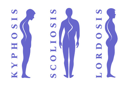 Diseases of the spine. Scoliosis, lordosis, kyphosis. Body posture defect. Human silhouettes isolated on white. Vector illustration.のイラスト素材