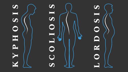 Diseases of the spine. Scoliosis, lordosis, kyphosis. Body posture defects. Back curvature. Spinal deformity types. Medical disease infographic. Diagnostic symptom. Vector illustrationのイラスト素材