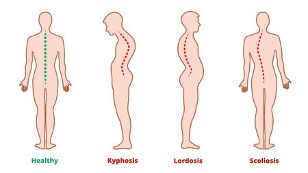 Diseases of the spine. Scoliosis, lordosis, kyphosis. Body posture defects. Back curvature. Spinal deformity types. Medical disease infographic. Diagnostic symptom. Vector illustrationのイラスト素材