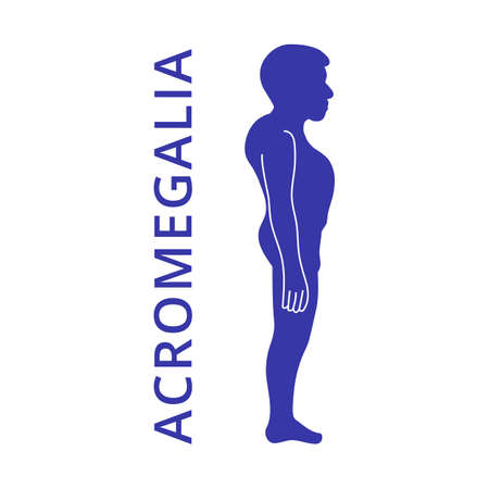 Acromegalia, acromegaly. Neuroendocrine disease. Pituitary gland disease. Silhouette of man, boy isolated on white background. Vector illustration.のイラスト素材