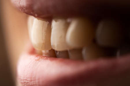 Close up photo of a woman with the cracked teeth. Teeth care concept. selective focus.の写真素材