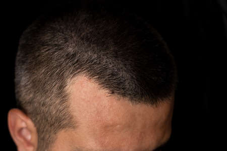 Close up photo of a man with hair lossの写真素材