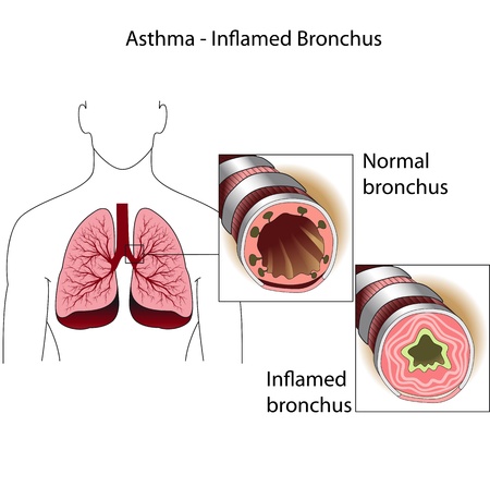 The bronchial tubes  of healthy person and a person suffering from bronchial asthma  Medical poster のイラスト素材