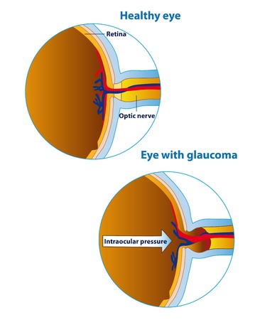 Illustration of an eyeball in a healthy state and in glaucoma のイラスト素材
