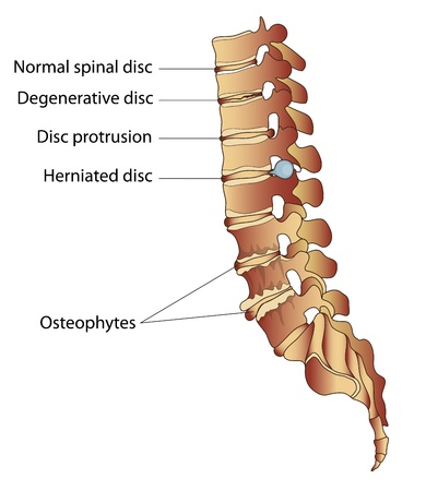 Some spinal diseases  disc herniation, osteophytes, degenerative changes in the disc, the disc protrusion のイラスト素材