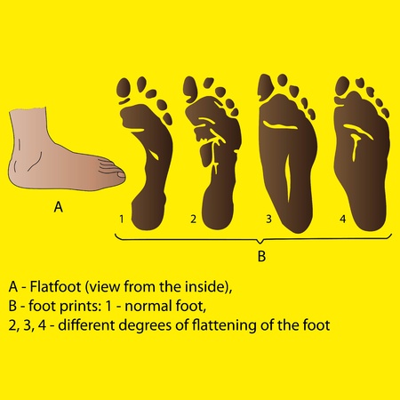 Different degrees of flattening of the foot   Medicine posterのイラスト素材