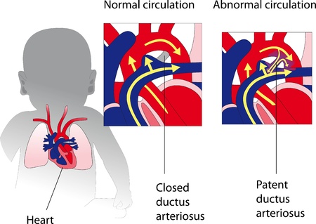 Patent ductus arteriosus  Medicine posterのイラスト素材