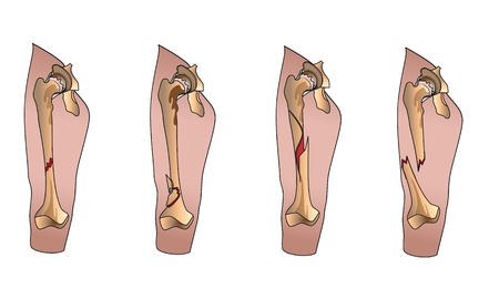 Types of bone fractures legのイラスト素材