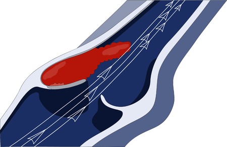venous thrombosisのイラスト素材