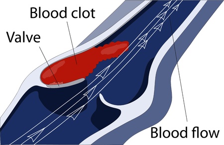 venous thrombosis 1のイラスト素材