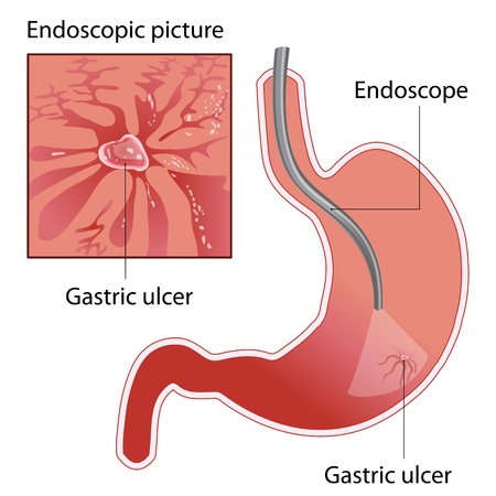 The endoscopy of gastric  ulcer  The image of the endoscope in the middle of the stomach のイラスト素材