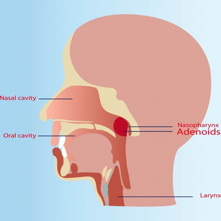 Adenoids in a childのイラスト素材