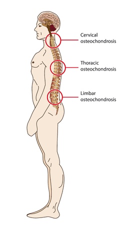 Types of spinal osteochondrosisのイラスト素材