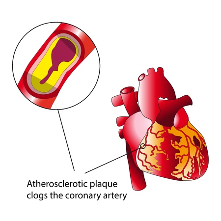 Atherosclerotic plaqueのイラスト素材