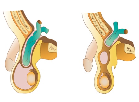 An inguinal hernia  Protrusion of abdominal cavity contents through the inguinal canalのイラスト素材