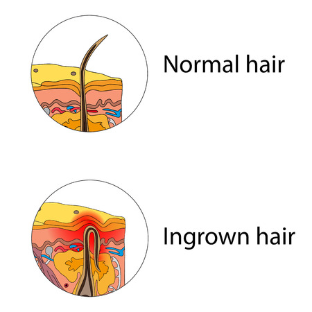 Ingrown and normal hairのイラスト素材