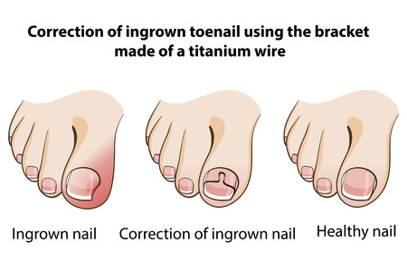 Correction of ingrown nailのイラスト素材