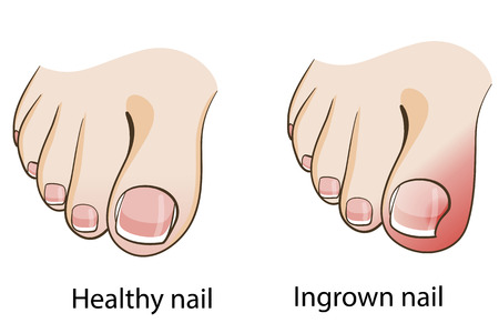 Ingrown toenailのイラスト素材