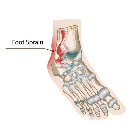 Foot Sprainのイラスト素材