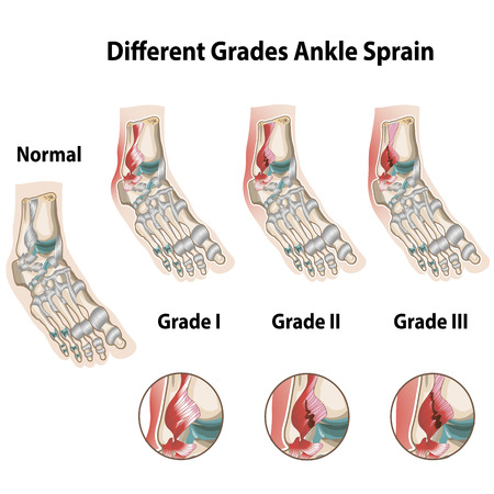 Different grades of ankle sprainsのイラスト素材