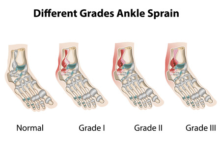 Grades of ankle sprainsのイラスト素材