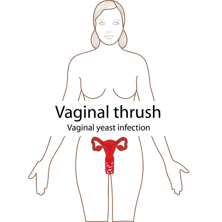 Vaginal thrush in the female body. Posterのイラスト素材