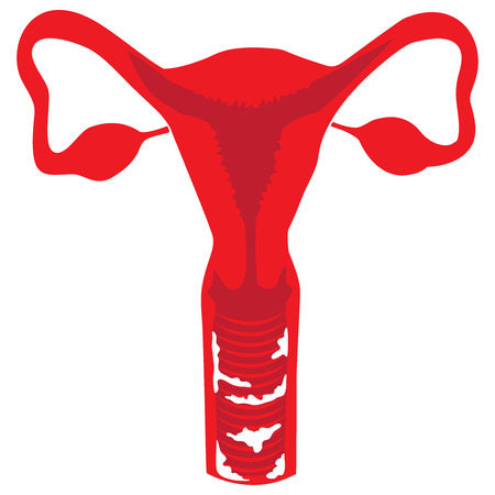Vaginal thrush section viewのイラスト素材