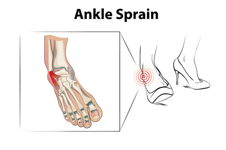 Ankle sprain injury from wearing high heelsのイラスト素材