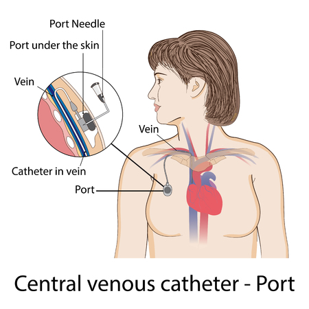 Port totally implantable venous access device. Medical posterのイラスト素材