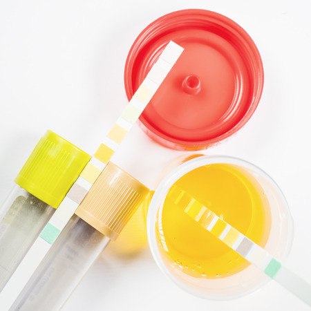 Three different plastic cups with the urine test from above.の写真素材