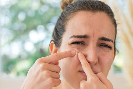 Portrait of young woman removing a pimple on her face and with a pain expressionの写真素材