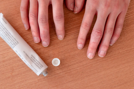Crop crose up female hands with chilblain placed on wooden table near opened white tube of ointment medicineの写真素材