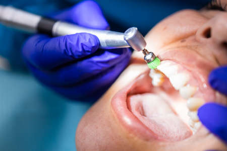 Unrecognizable dentist using dental polishing brush to polish and clean a female patients teeth
