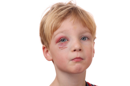 Portrait of a young boy with black eye on white backgroundの写真素材