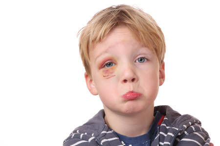 Portrait of a young boy with black eye on white backgroundの写真素材