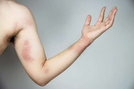 Man getting red skin rash at his body part - people with skin allergy problem conceptの写真素材