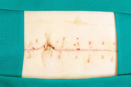 Closeup image of scar over abdomen after surgeryのeditorial素材