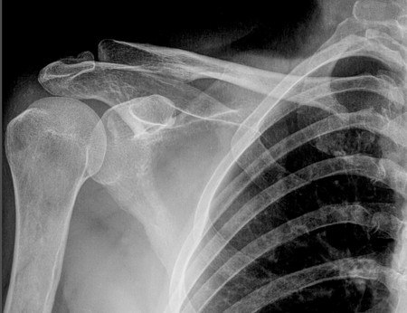 shoulder jointの写真素材