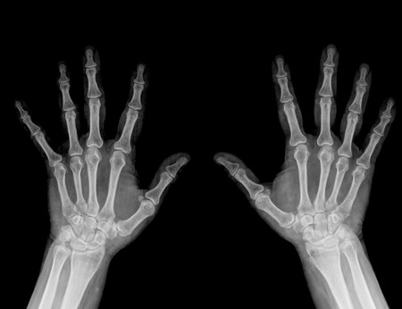 radiograph of the bones of the handの写真素材