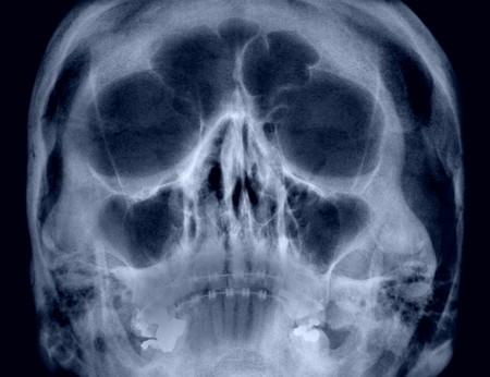 frontal skull radiographの写真素材