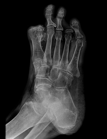 toe amputation radiographyの写真素材
