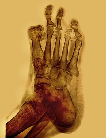 radiography toe injuryの写真素材